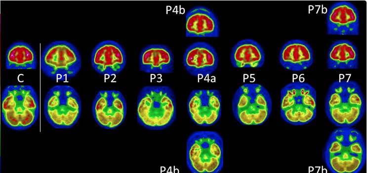 Child PET Scan